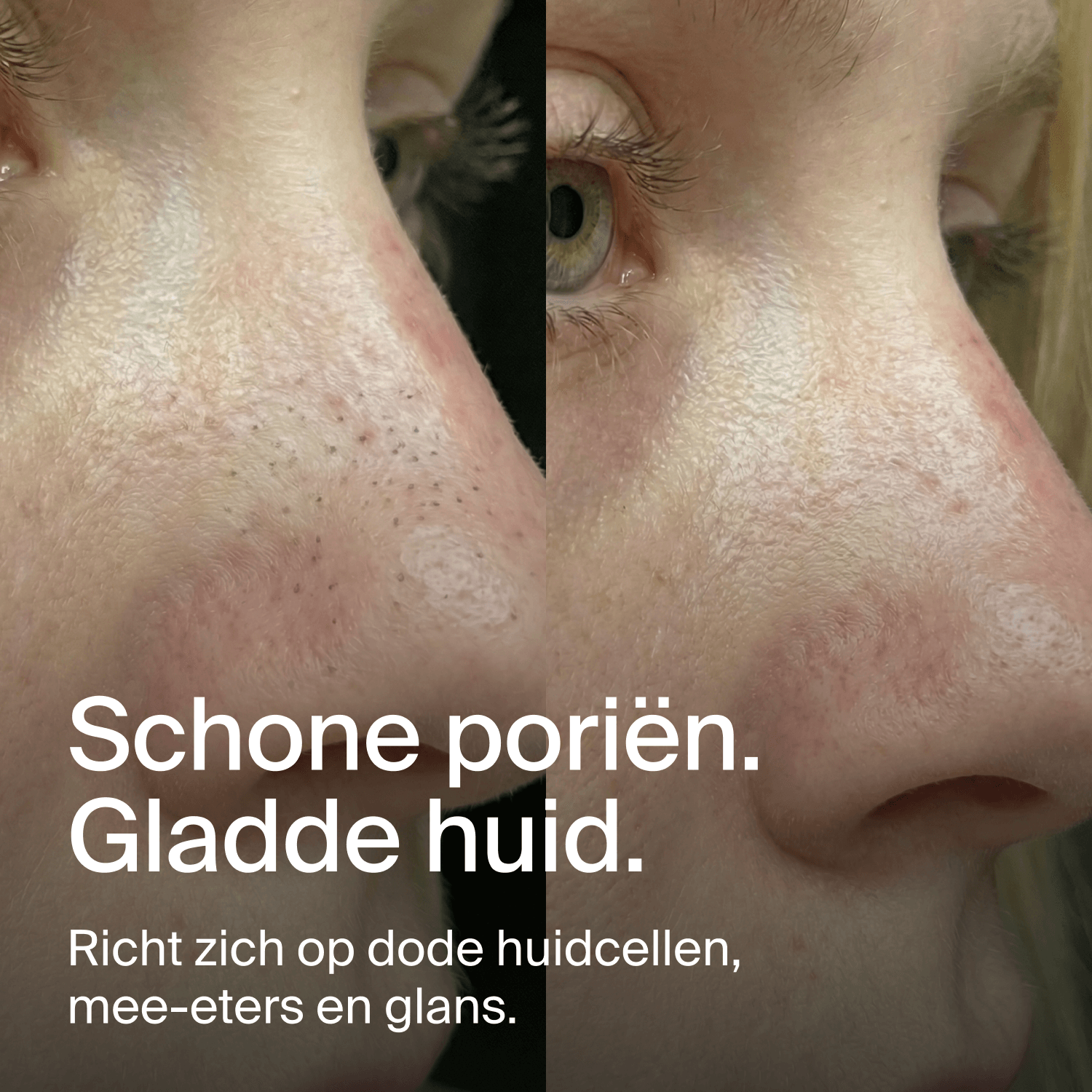 Nose Patches