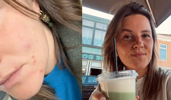 Nachdem ich mit der Pille aufgehört habe, ist meine Haut total ausgerastet.