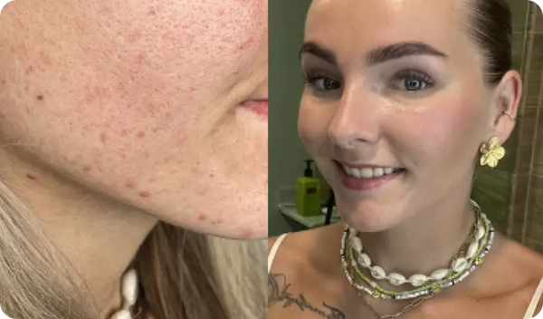 Die roten Flecken verschwinden schneller