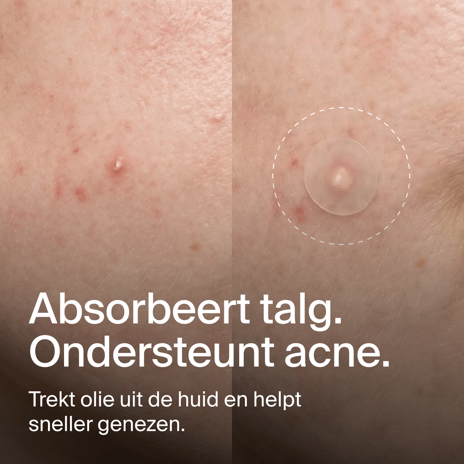 Clear Dots – Akne-Patches