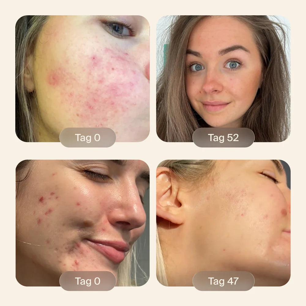 Vier echte Vorher/Nachher-Transformationen von Cloudless Clear+ Kundinnen — Ergebnisse von Woche 2 bis Woche 12